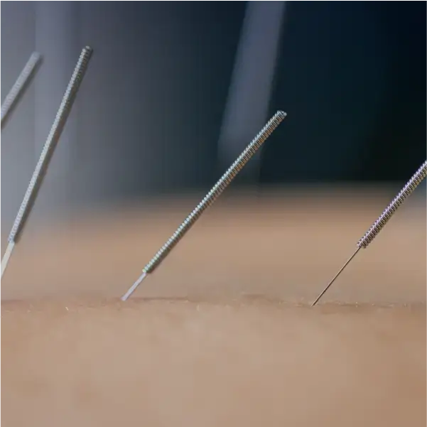 Acupuntura